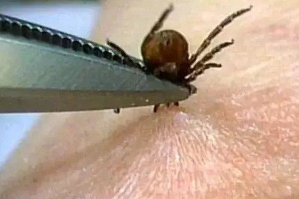 被蜱虫咬后有哪些症状，会导致发热、脏器功能减退等