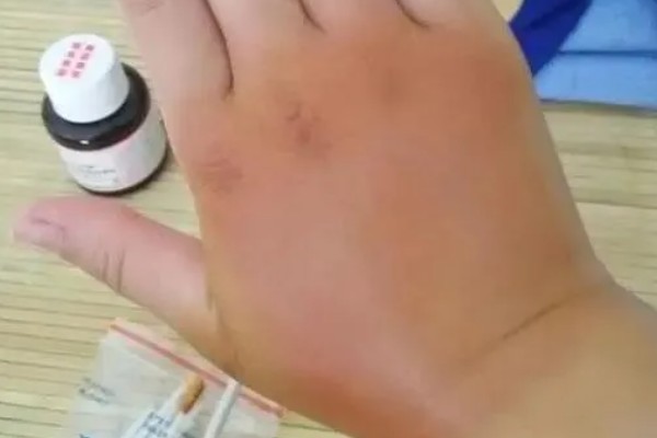 被马蜂蛰了如何处理，首先要迅速远离马蜂巢穴